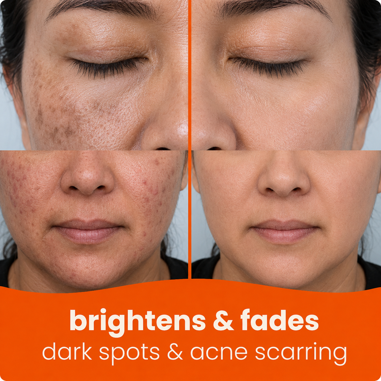 🔥Last Day 68% OFF-Prionne Turmeric Kojic Glow Pads